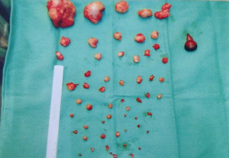 extracted fibroids