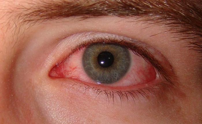 синдрома сухого глаза