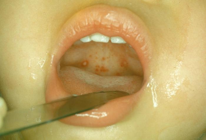 herpetic sore throat in children photo