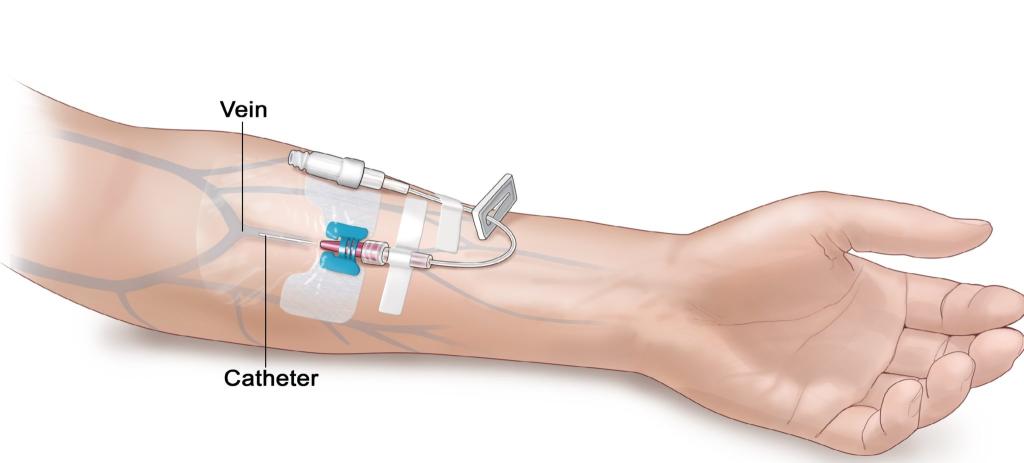постановка внутривенного катетера