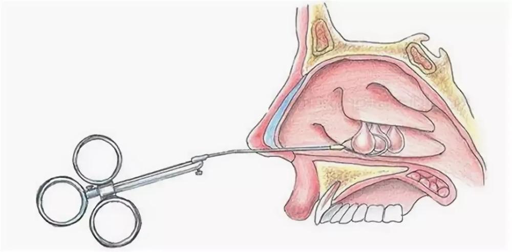 Полит носа. Полипозный синусит операция. Хронический полипозный гайморит.