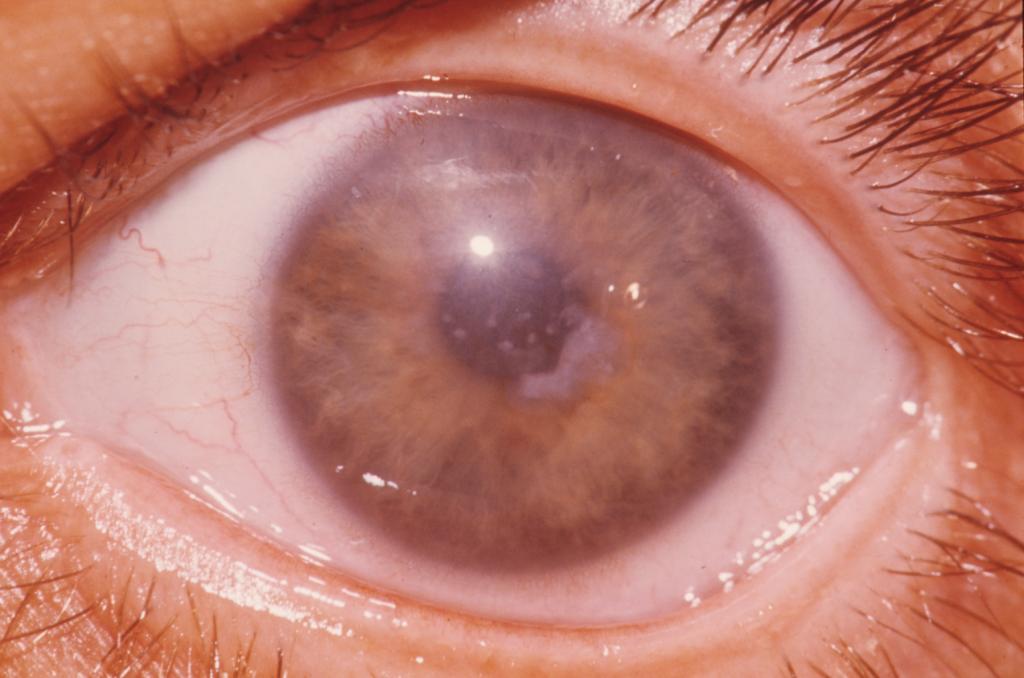 дистрофия глаза