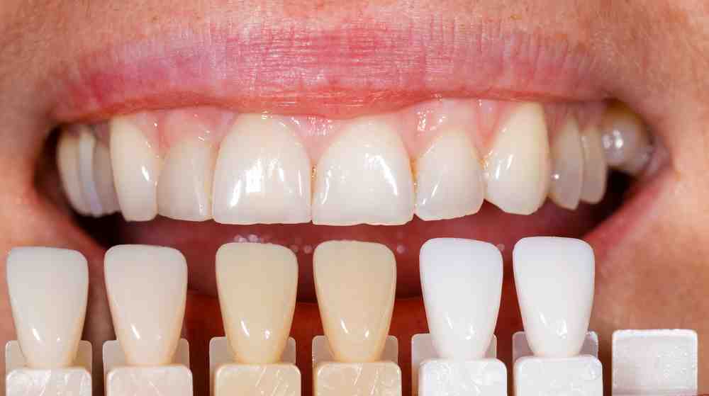 unique shades of tooth enamel