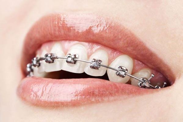 зубные ортопедические конструкции
