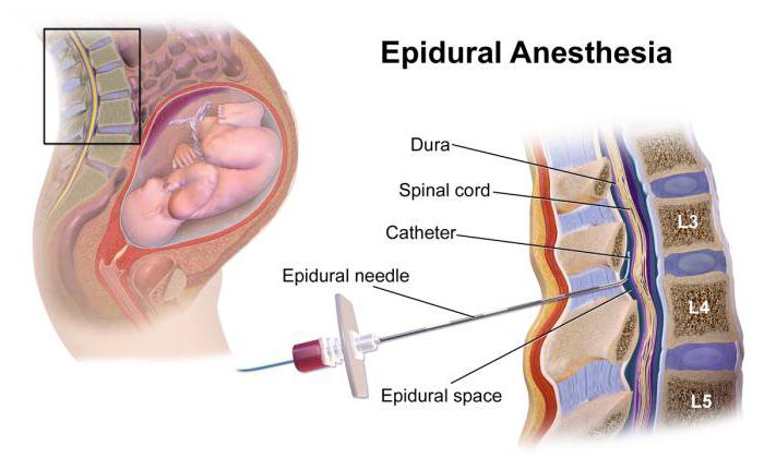 Перидуральная анестезия в родах