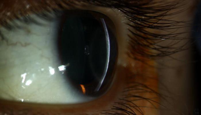 Герпетический кератит глаза