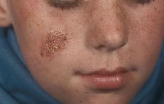 frostbite of the cheeks in a child Komarovsky