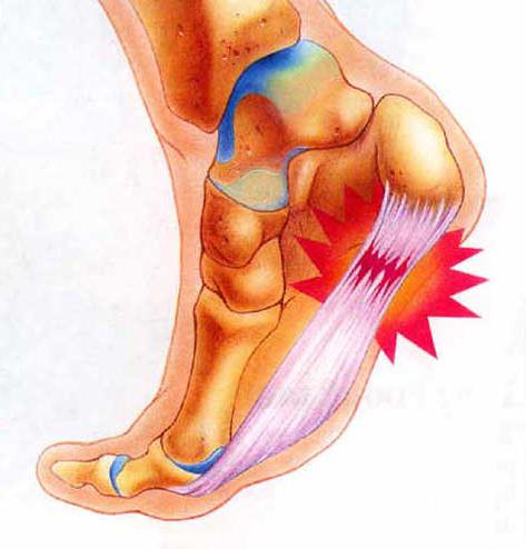 Лечение подошвенного фасцита