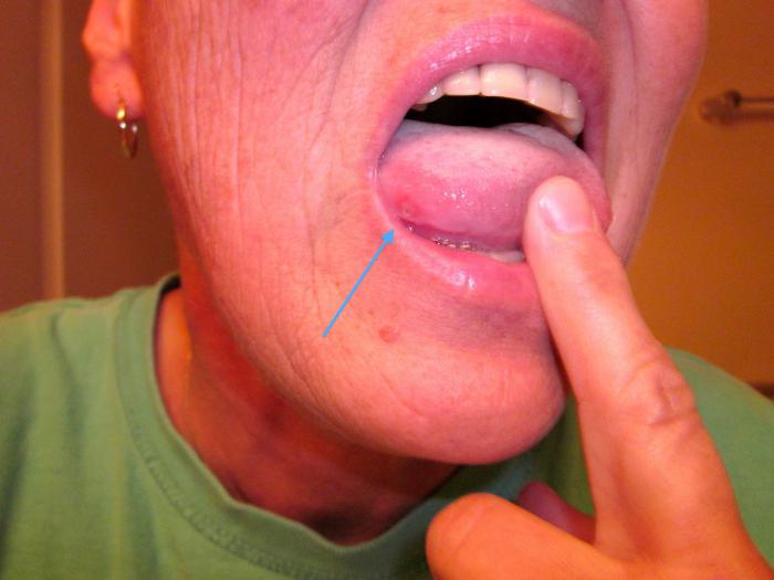 Herpes on the tongue, photo