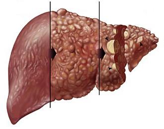 total bilirubin elevated causes