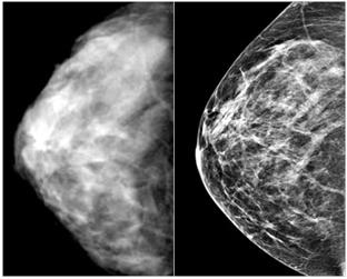 маммография или узи