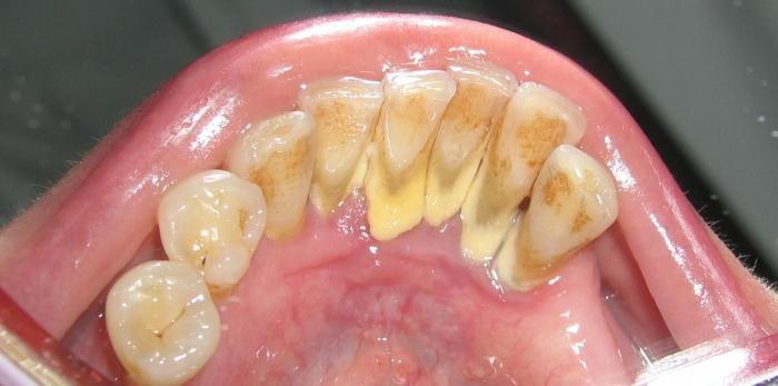 зубной камень удаление