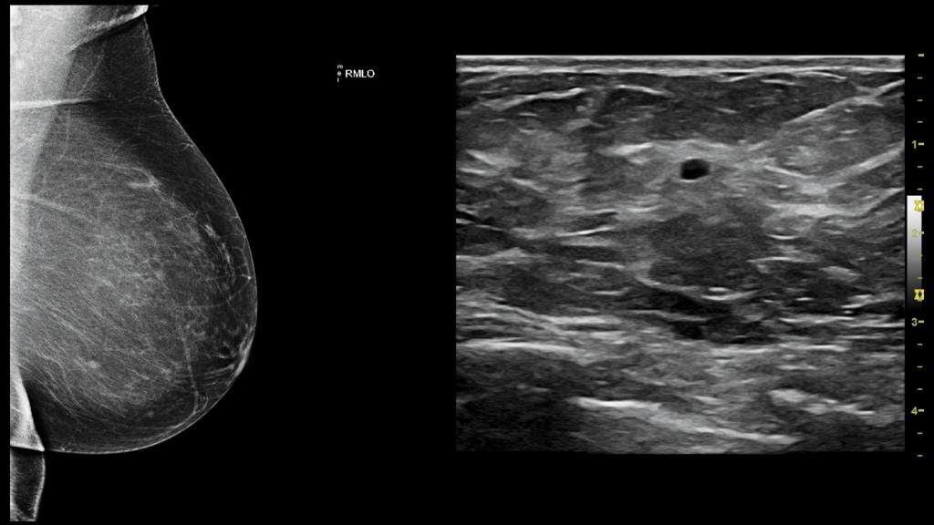 ultrasound of the chest
