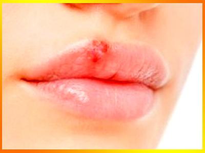 как лечить простуду на губах