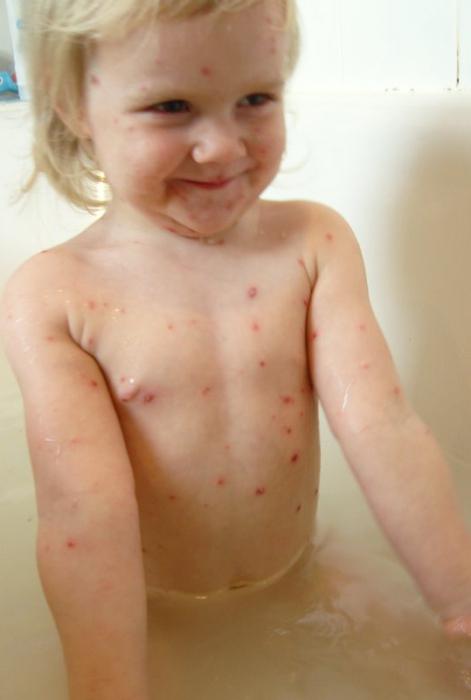 chickenpox bathe or not