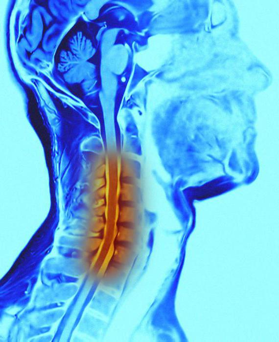 Цервикалгия на фоне шейного остеохондроза