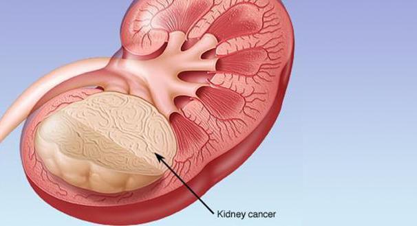 удаление почки при раке