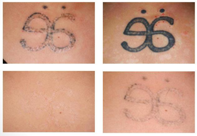 удаление татуировки лазером