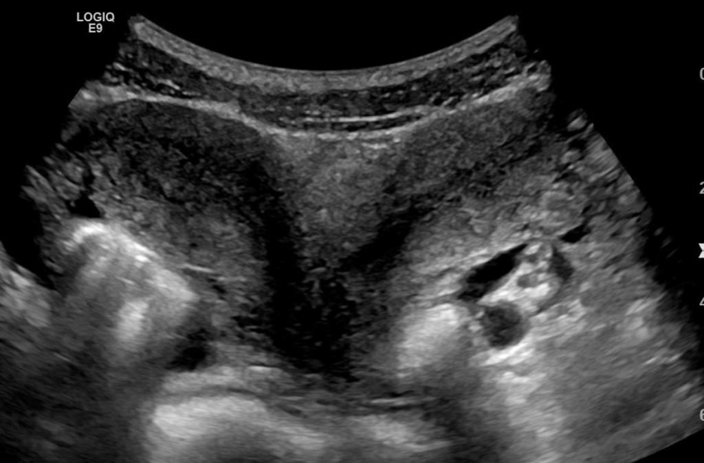 Как выглядит двурогая матка у женщины при беременности фото