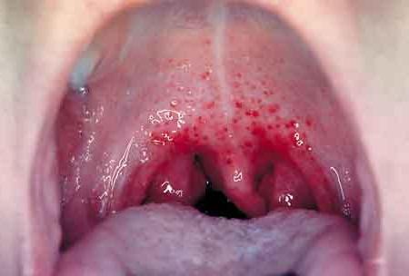 Боль в горле и другие сигналы хронического тонзиллита