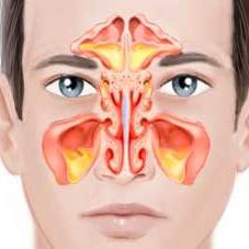 Sinusitis signs and treatment