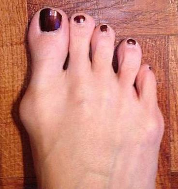 шишки на больших пальцах ног