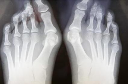 шишки на пальцах ног лечение