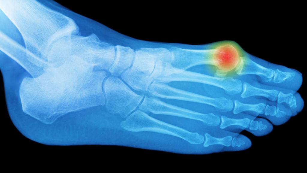 Воспаление косточки на большом пальце ноги: лечение народными средствами