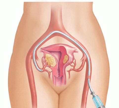 How to cure fibroids without surgery