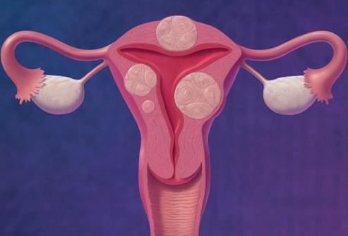 Is it possible to cure uterine fibroids