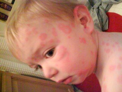 аллергия на коже лица