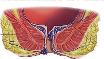 Hemorrhoids in men