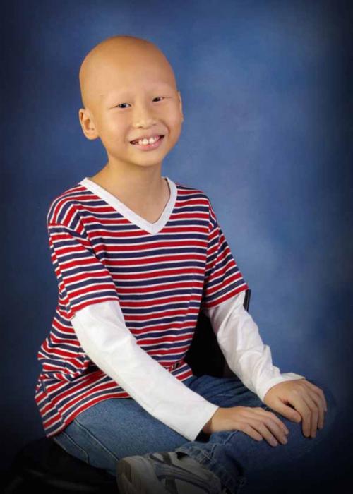 Total alopecia in children