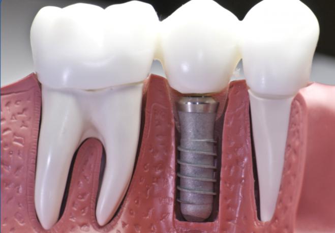 Как ухаживать за имплантами зубов