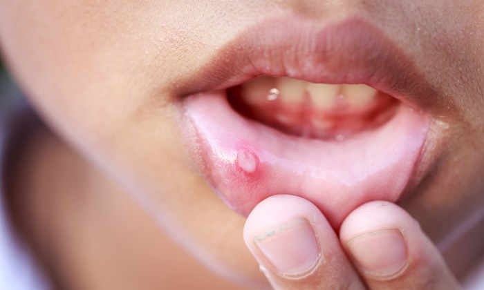 Лекарство от стоматита во рту
