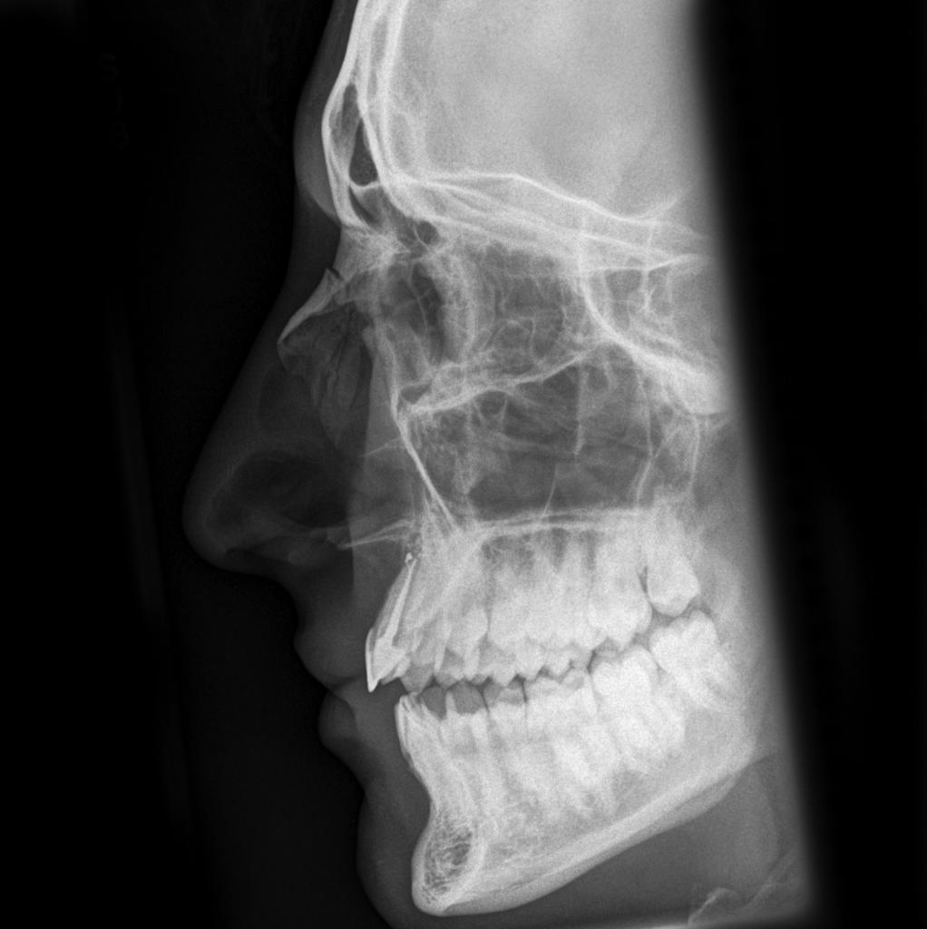 Кости носа рентген норма