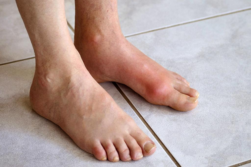 Чем лечить подагру на большом пальце ноги: фото, симптомы и методы лечения