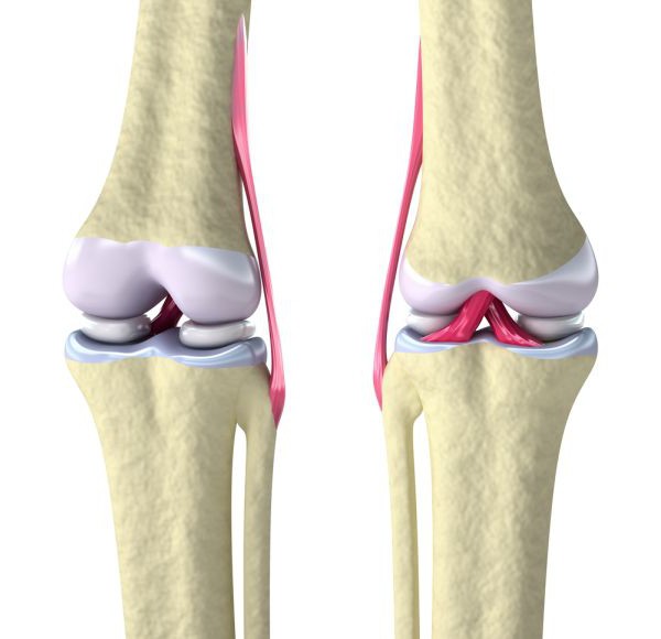 травма мениска симптомы