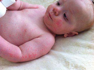 аллергия у ребенка профилактика