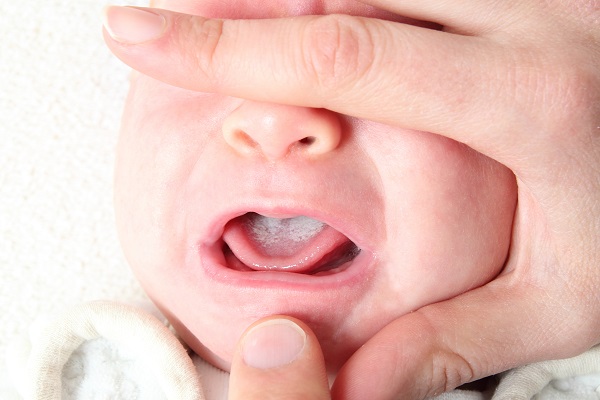 White plaque on the tongue of the newborn