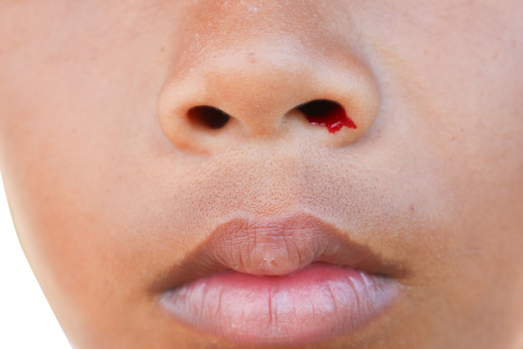 почему у ребенка идет кровь из носа