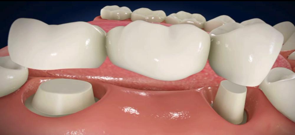имплант жевательного зуба