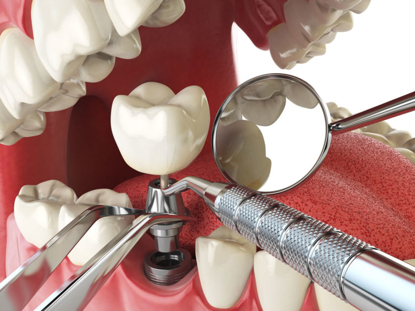 В какой стоматологии лучше ставить импланты