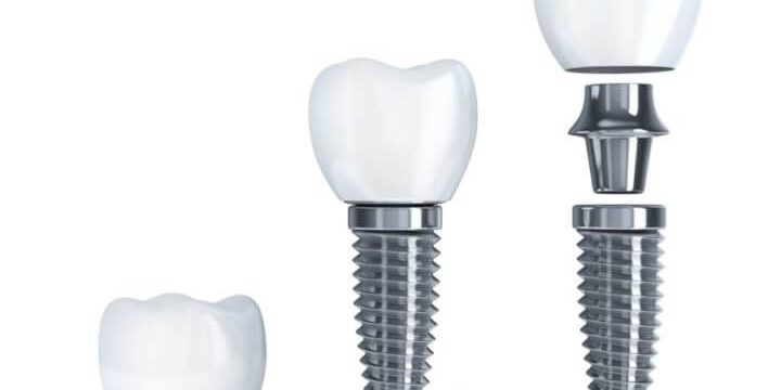 Какие импланты лучше ставить на зубы
