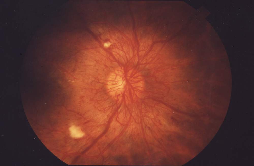признаки ретинопатии