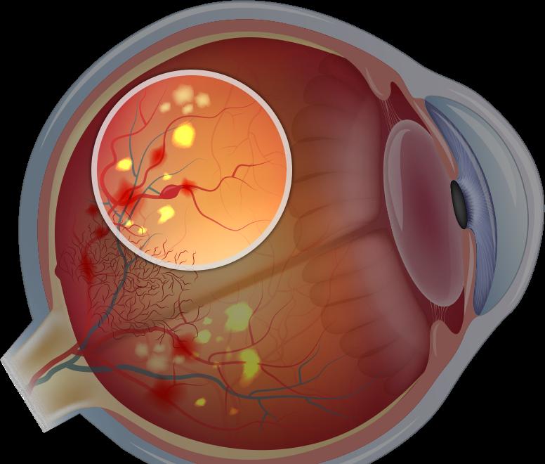 заболевание ретинопатия
