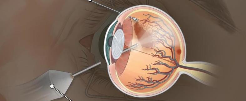 стадии ретинопатии