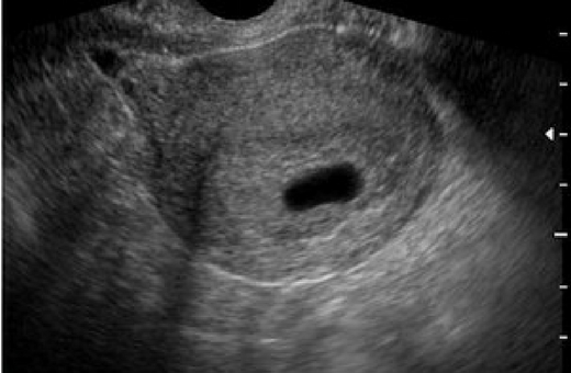 Фото эмбриона 4 5 недель беременности