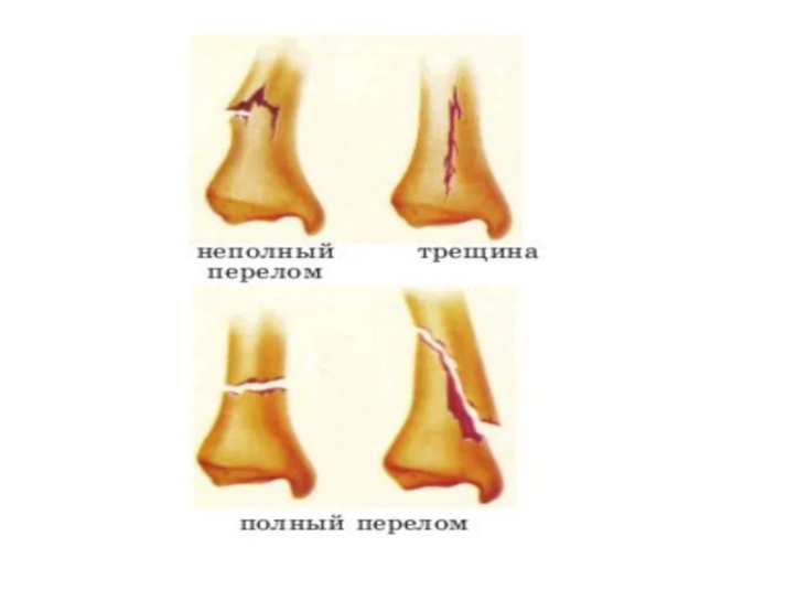 Виды переломов картинки