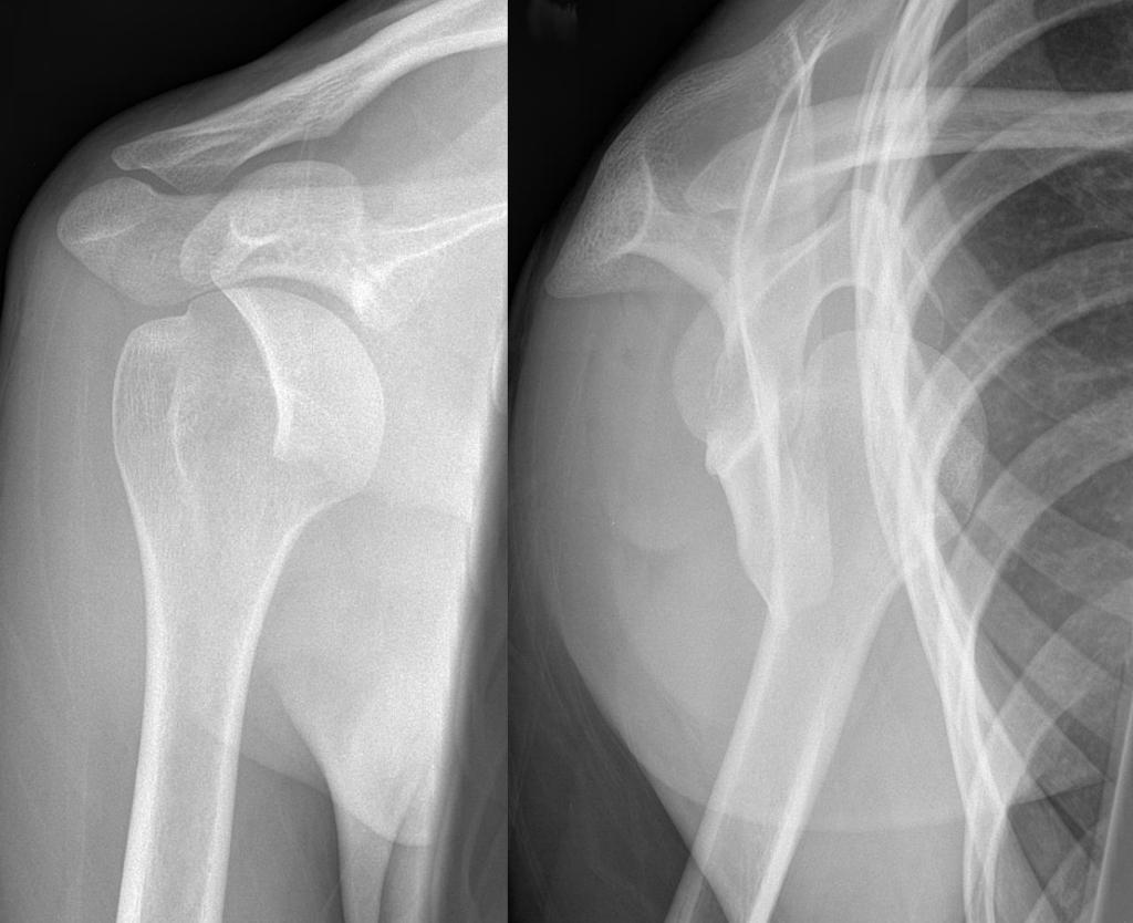 Импрессионный перелом плечевой кости. Anterior Shoulder dislocation. Задний вывих плечевой кости. Нижний подвывих головки плечевой кости. Нижний подвывих плечевой кости.